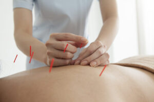 Acupuncture for healing pain